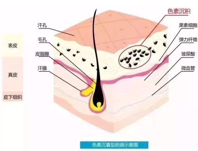【同济·科普】原来因为这样做,才导致疤痕色素沉着的