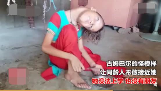                     11岁女孩脖子向左扭曲90度，竟因小时候跌倒，家人没重视