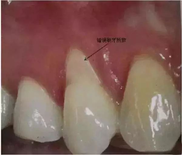 医生,我的牙龈萎缩了,能再恢复吗?