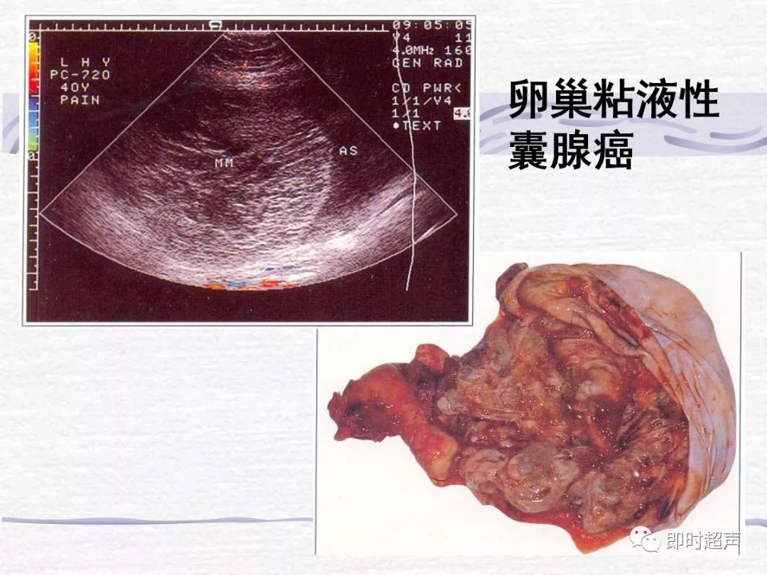 卵巢肿瘤的超声诊断