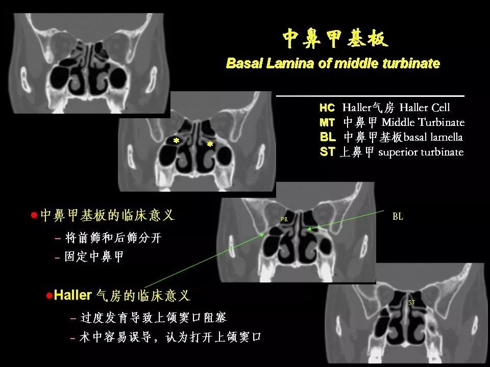 鼻腔,鼻窦的ct解剖及该区域常见疾病的影像学诊断 | 影像天地