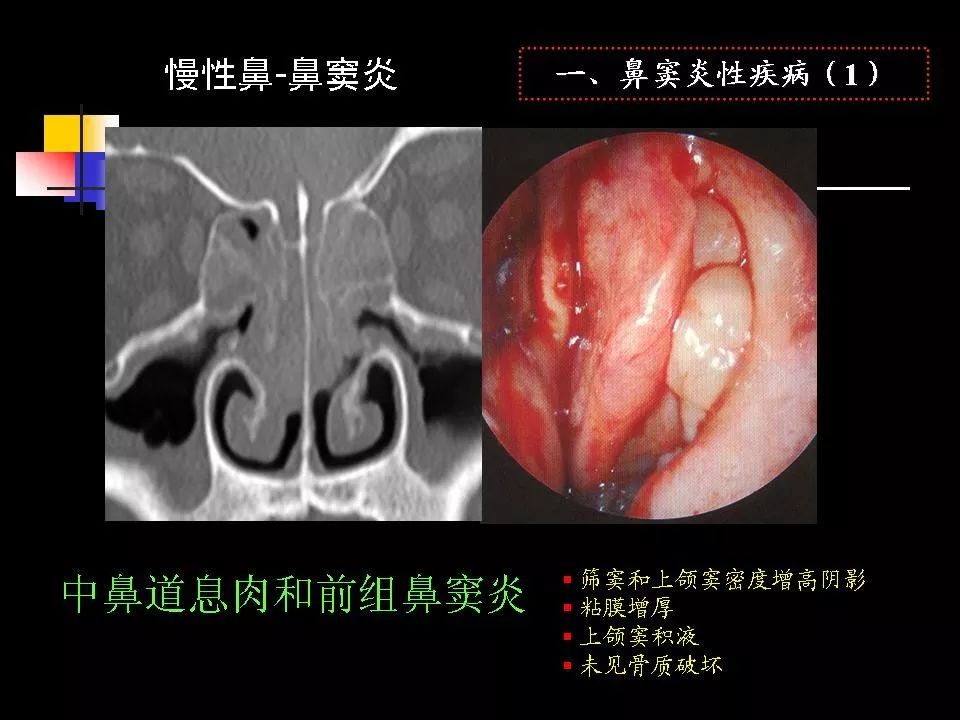 鼻腔,鼻窦的ct解剖及该区域常见疾病的影像学诊断 | 影像天地