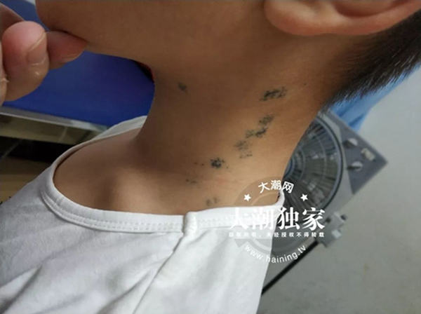                     触目惊心！10岁男孩脖子上全是针眼！竟是爸妈雇人扎的！原因想不到...