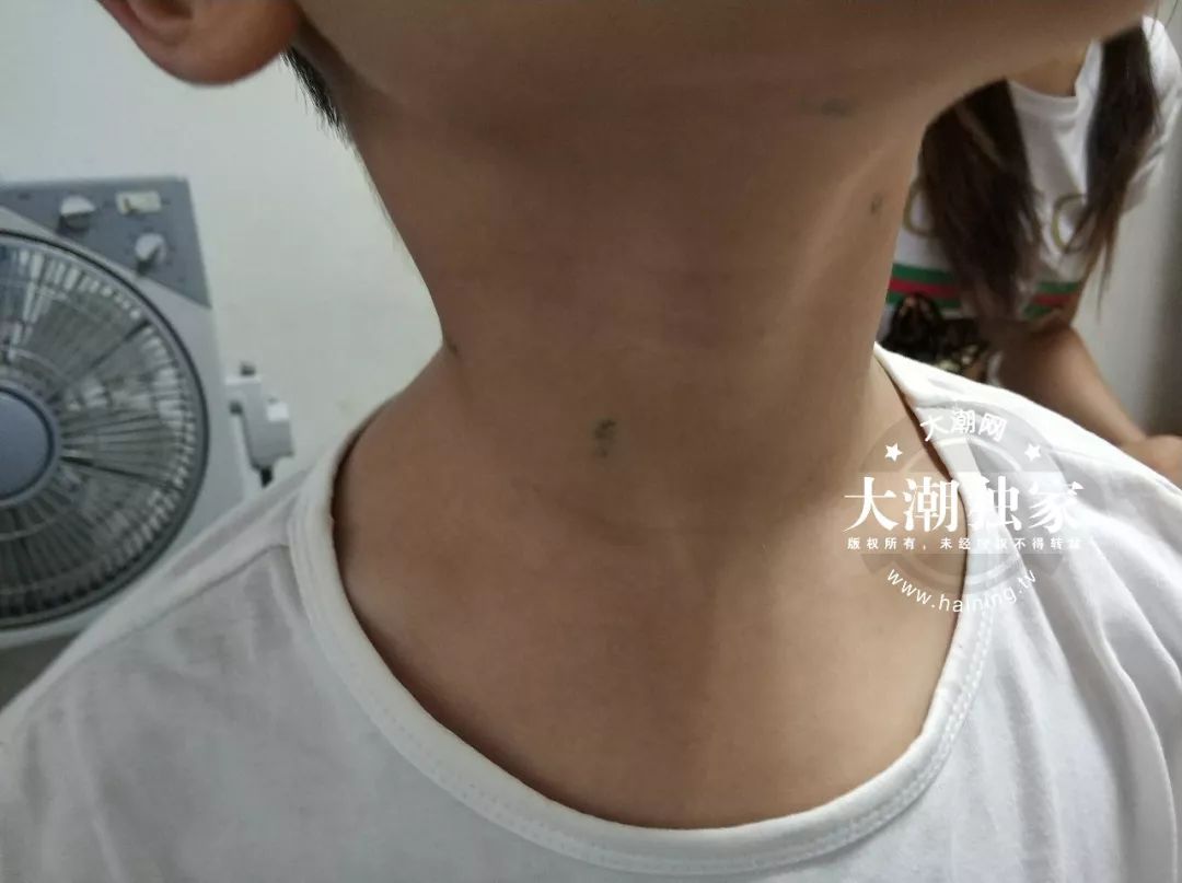                     10岁男孩脖子上全是针眼！竟是爸妈雇人扎的！原因让人意想不到