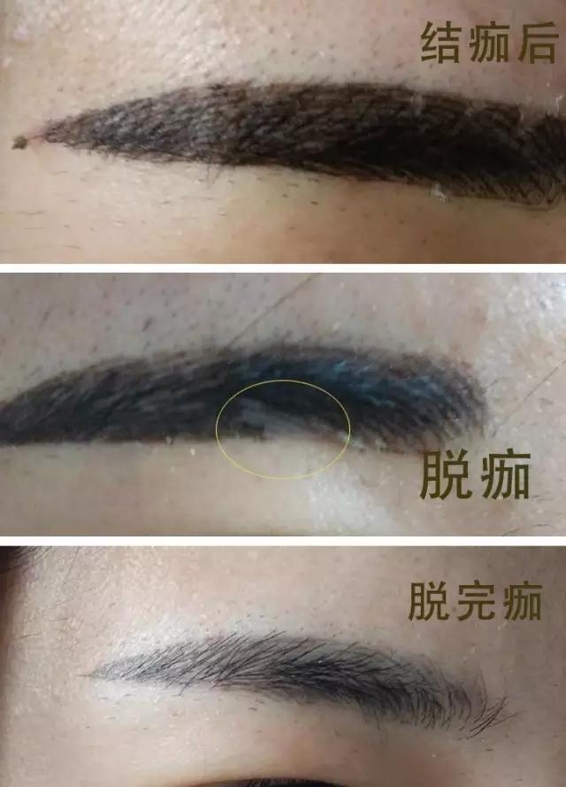 半永久定妆眉脱痂全过程