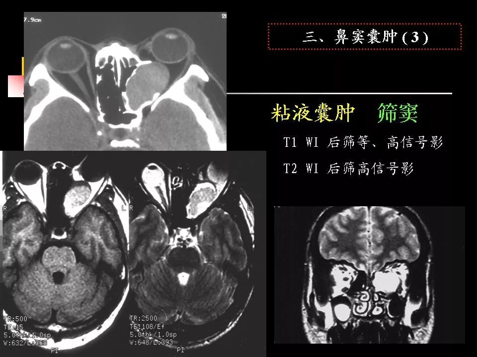 鼻腔,鼻窦的ct解剖及该区域常见疾病的影像学诊断 | 影像天地