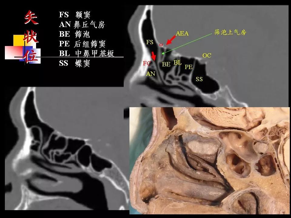 鼻腔鼻窦的ct解剖及该区域常见疾病的影像学诊断影像天地