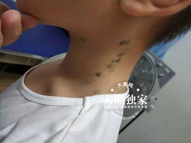                     可怕！10岁男孩脖子上全是绿色针眼，竟是爸妈雇人扎的！原因让人无语...