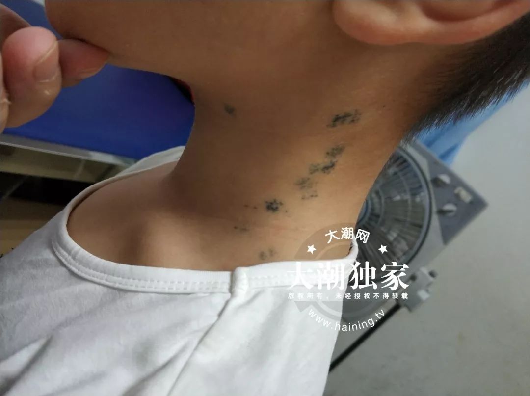                     10岁男孩脖子上全是针眼！竟是爸妈雇人扎的！原因让人意想不到