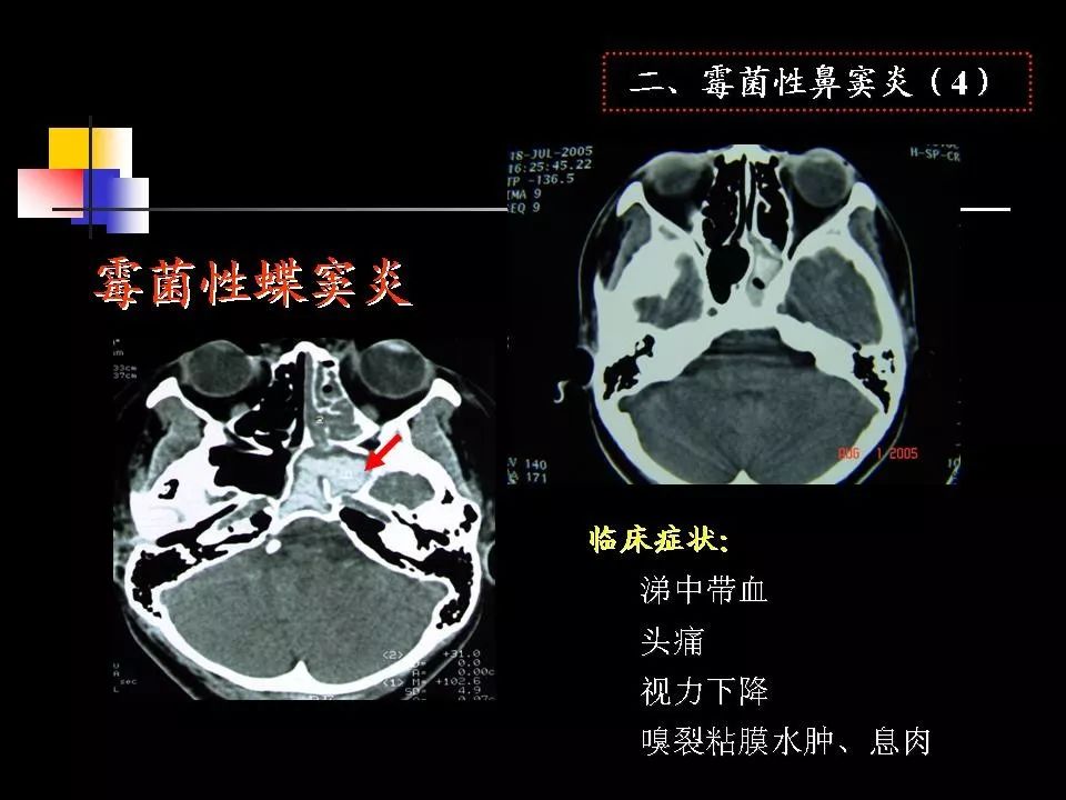 鼻腔鼻窦的ct解剖及该区域常见疾病的影像学诊断影像天地