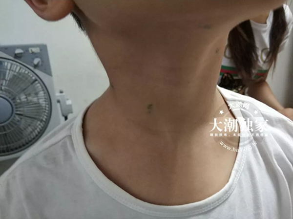                     触目惊心！10岁男孩脖子上全是针眼！竟是爸妈雇人扎的！原因想不到...