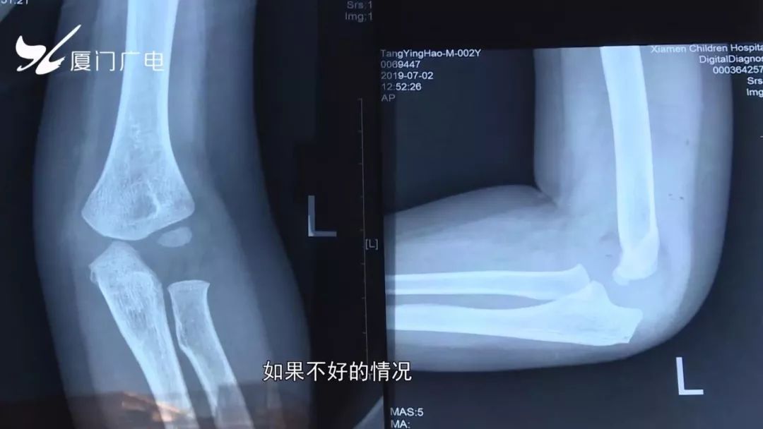 骨折了就先打石膏处理,如果发展的好的话,至少要一个月才能拆石膏,拆