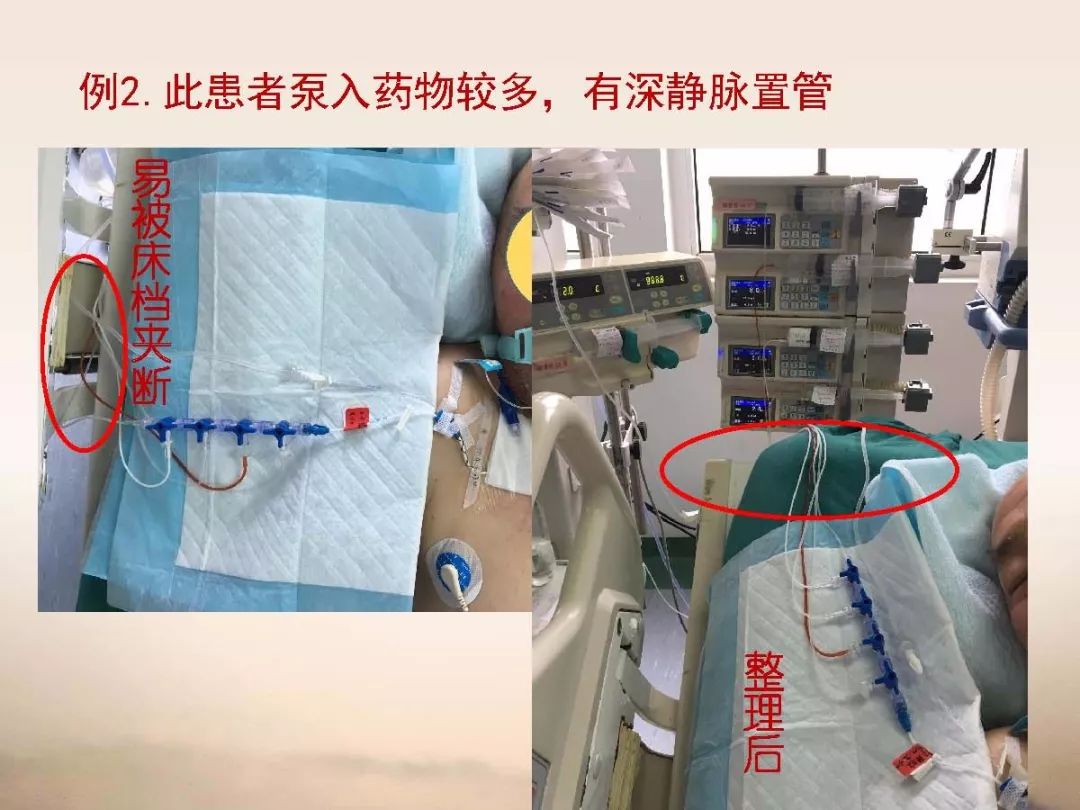 ppt资源危重患者使用留置管路的护理