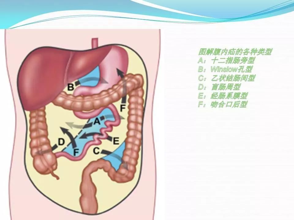 十二指肠旁疝的影像学表现点击原文可查看直播