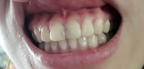 牙性:上颌骨是不突的,上前牙往前倾斜的程度较大