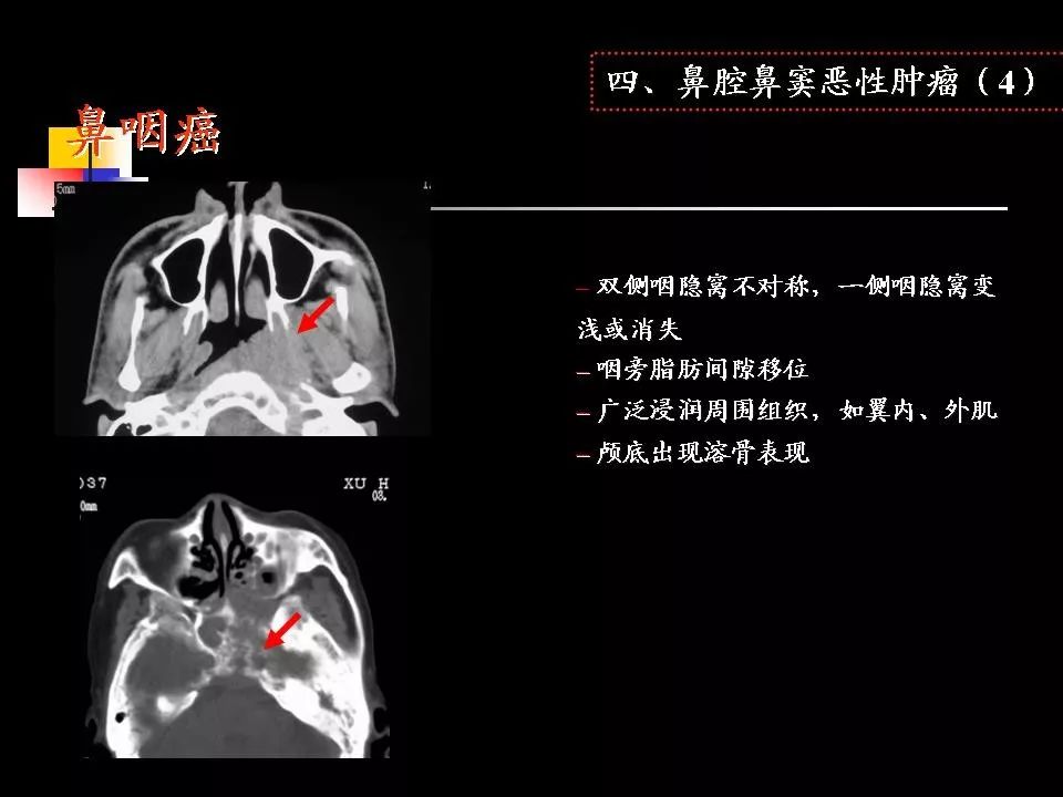 鼻腔,鼻窦的ct解剖及该区域常见疾病的影像学诊断 | 影像天地