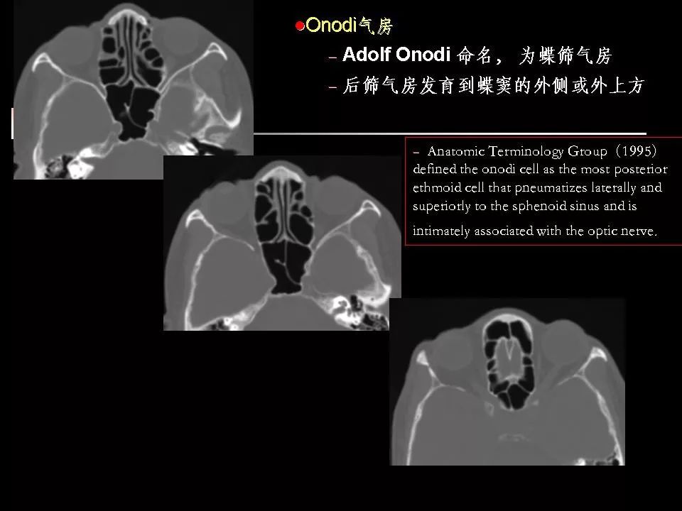 鼻腔,鼻窦的ct解剖及该区域常见疾病的影像学诊断 | 影像天地