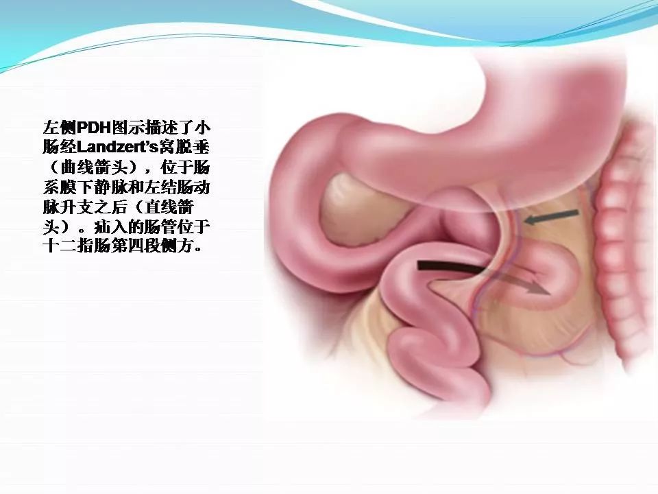 十二指肠旁疝的影像学表现(点击原文可查看直播)