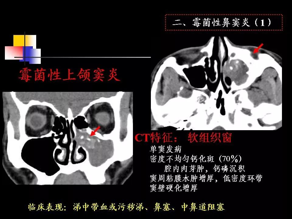 鼻腔,鼻窦的ct解剖及该区域常见疾病的影像学诊断 | 影像天地