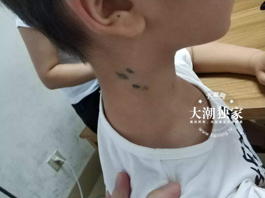                     10岁男孩脖子上全是针眼！竟是爸妈雇人扎的！原因让人意想不到