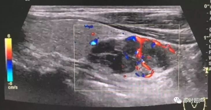 超声检查:甲状腺旁腺区可探及3个团块回声,大小及位置分别为:31mm