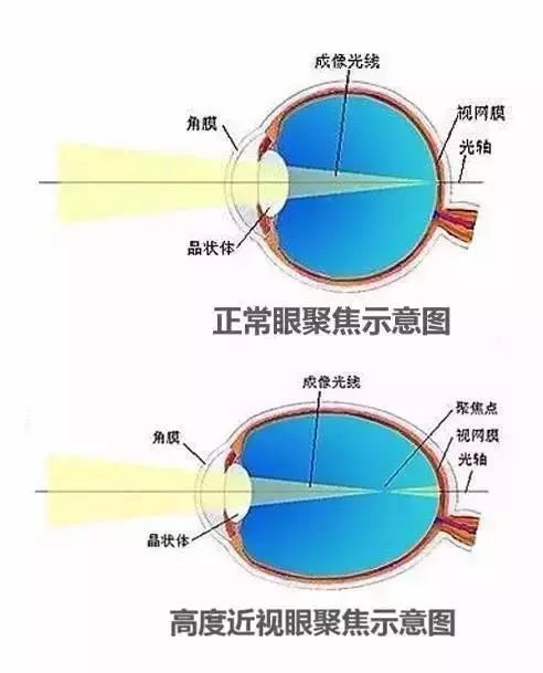 快来看这张图↓为什么说高度近视的眼球非常脆弱呢?