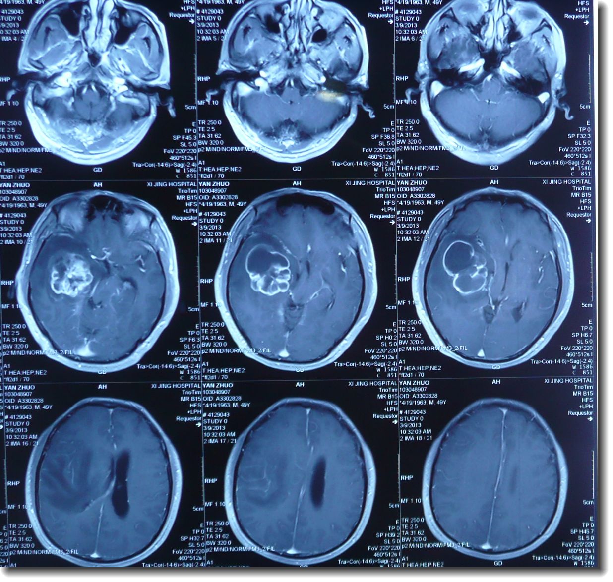 「胶质瘤手术案例」巨大丘脑胶质瘤压迫脑干_INC-国际神经外科医生集团