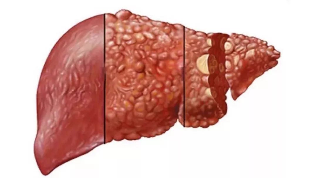 【肝胆名医专栏】得了酒精肝不治疗会怎样?可能会给你