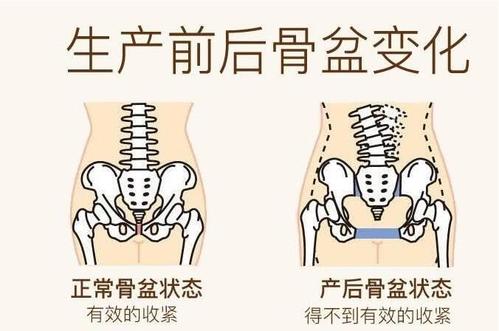 生完宝宝后身材大走样,产后骨盆如何恢复?