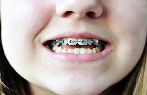 牙齿矫正毕竟是一个过程比较复杂的技术,所以多多少少会对孩子有一些