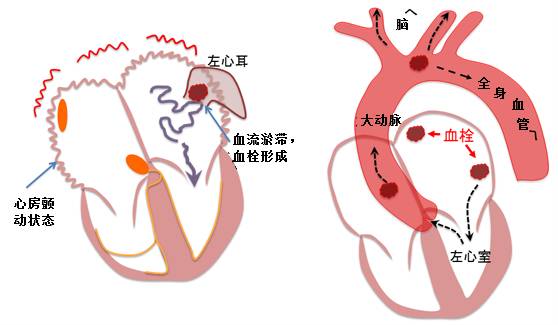 发生心房颤动时,心房是以600次/分钟左右的速度颤动,这就意味着,心房