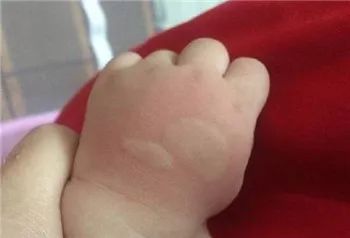                    2岁孩子涂风油精险丧命？夏天防蚊一定要知道这些事！