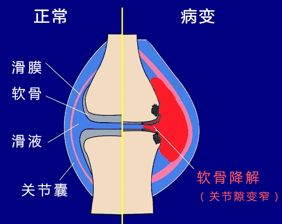 膝盖滑膜炎怎么治疗效果好 fda5117030594249888ba82aa674ff76.gif