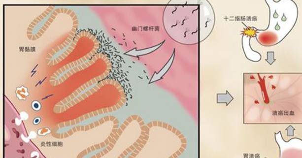 (幽门螺杆菌)入侵的五个因素共餐幽门螺杆菌主要的传播途径是口口传播