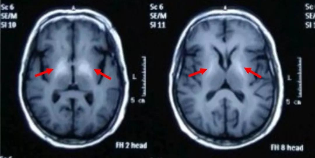 患者头颅磁共振t1序列可见,双侧基底节区以苍白球为主区域呈短t1