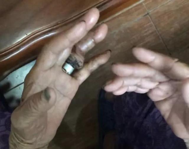 戒指深嵌老太手指致腐烂女子被困电梯