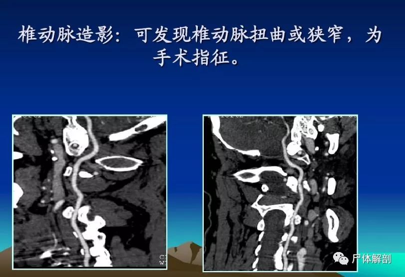 图解颈椎精细解剖颈椎病