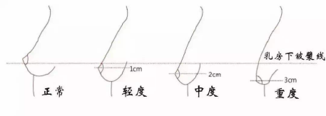 脂肪丰胸后会不会下垂? 百乐宫手机版