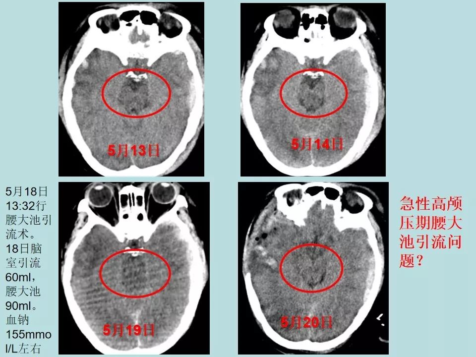 重型颅脑损伤患者环池影像改变的临床意义颅脑创伤神经