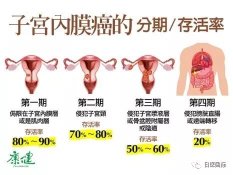 发生率第1名的妇科癌症　异常出血莫轻忽！