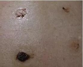 疱疹用什么药可以擦 bbf4bfe950d147acb1daf7e9fe9b92fd.jpeg