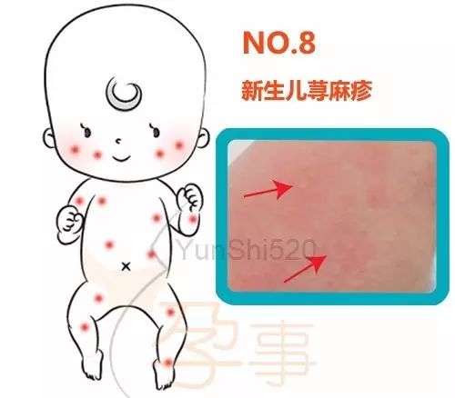 痱子、湿疹……傻傻分不清，看看这张图就懂了