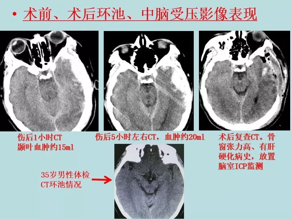 重型颅脑损伤患者环池影像改变的临床意义颅脑创伤神经