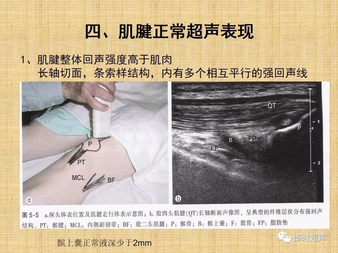 肌肉骨骼疾病的超声诊断