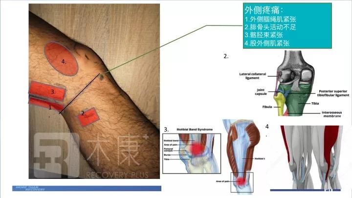 acl术后康复第1期前叉术后哪些部位可能出现疼痛该怎么处理