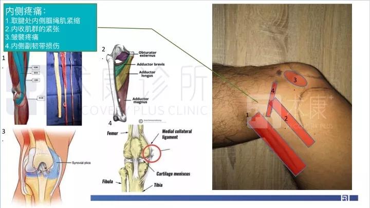 大腿内侧疼痛