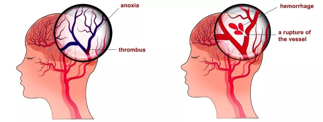 缺血性脑卒中,即脑部血管中的血栓引发堵塞,进而导致神经组织坏死.
