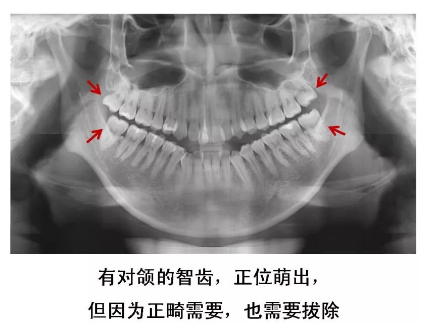 某明星拔完智齿,脸竟变成了这样…到底该不该拔?今天和你说清楚