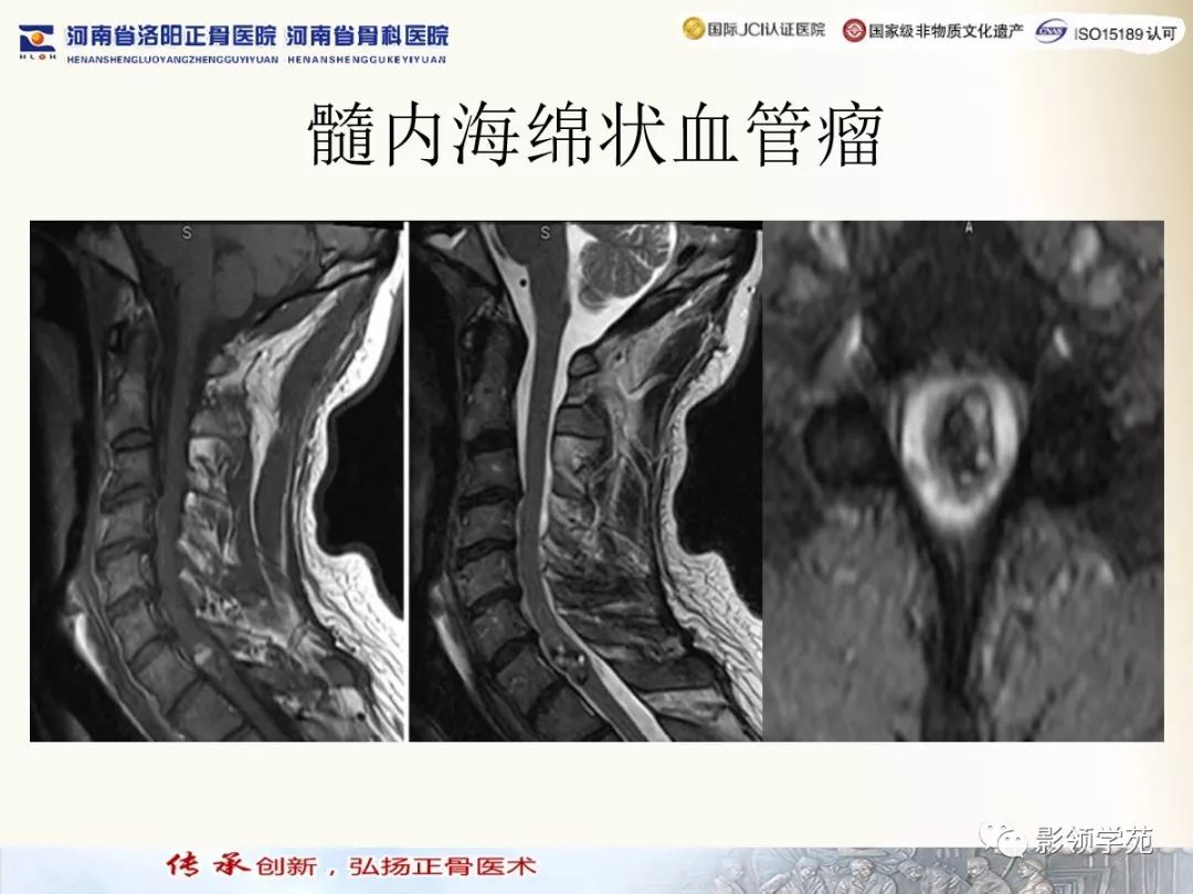 【经典】椎管内常见肿瘤MR诊断_脊髓