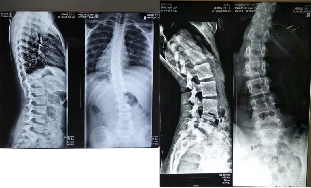图为脊柱侧弯患儿们的x光片
